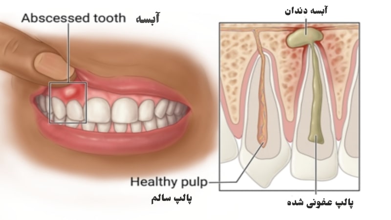 عکس آبسه دندان