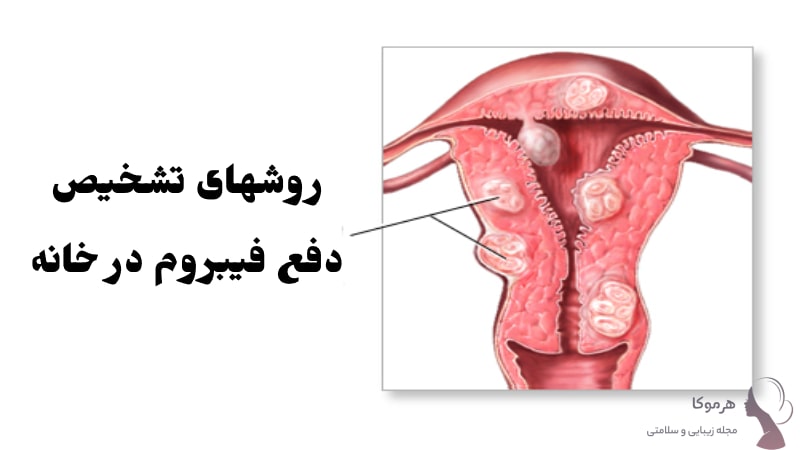 چطور بفهمیم فیبروم رحم دفع شده؟