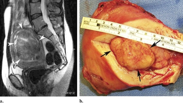عکس فیبروم رحم دفع شده