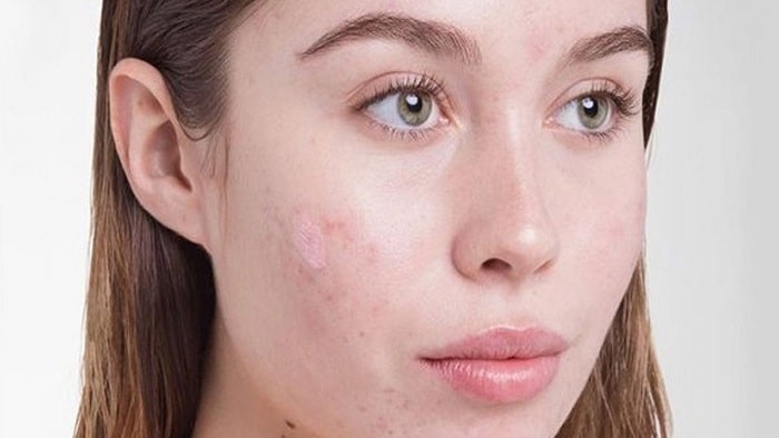 راه های از بین بردن جوشای زیر پوستی و ریز صورت
