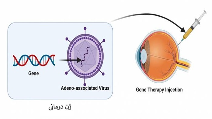 ژن درمانی بیماریهای چشمی