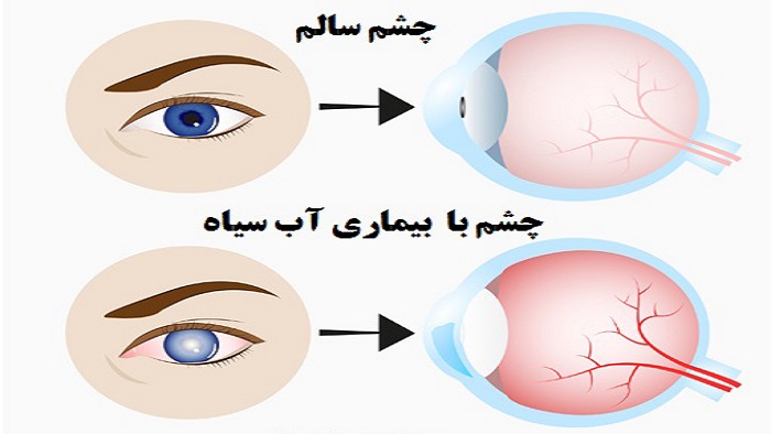 بیماری گلوکوم مادرزادی