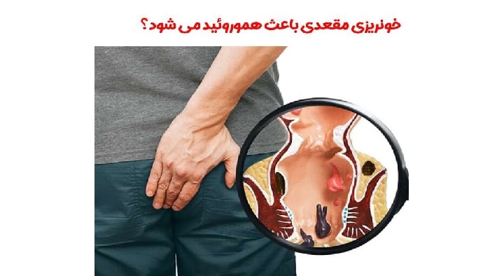 عکس بواسیر یا هموروئید شفا کلینیک